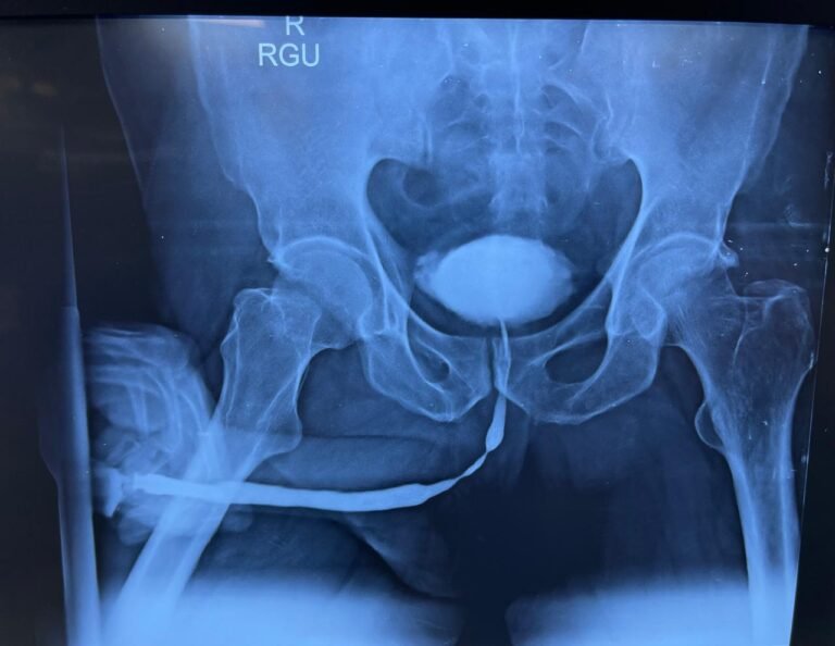 X-ray of Retrograde Urethrogram