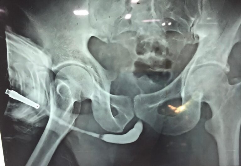 X-ray of Pelvic Fracture